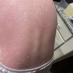 Memorial Hermann-GoHealth Urgent Care - Rash from bed diagnosis