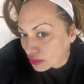 LaserAway - Skin pre treatment! - Medical Spas Near Me - Folsom, California