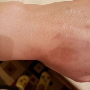 Fabulous Nails & Spa - Pictures can't show how bad the skin is. BEWARE GIRLS. - Nail Salons Near Me - Manteca, California Fabulous Nails & Spa - Pictures can't show how bad the skin is. BEWARE GIRLS. - Nail Salons Near Me - Manteca, California