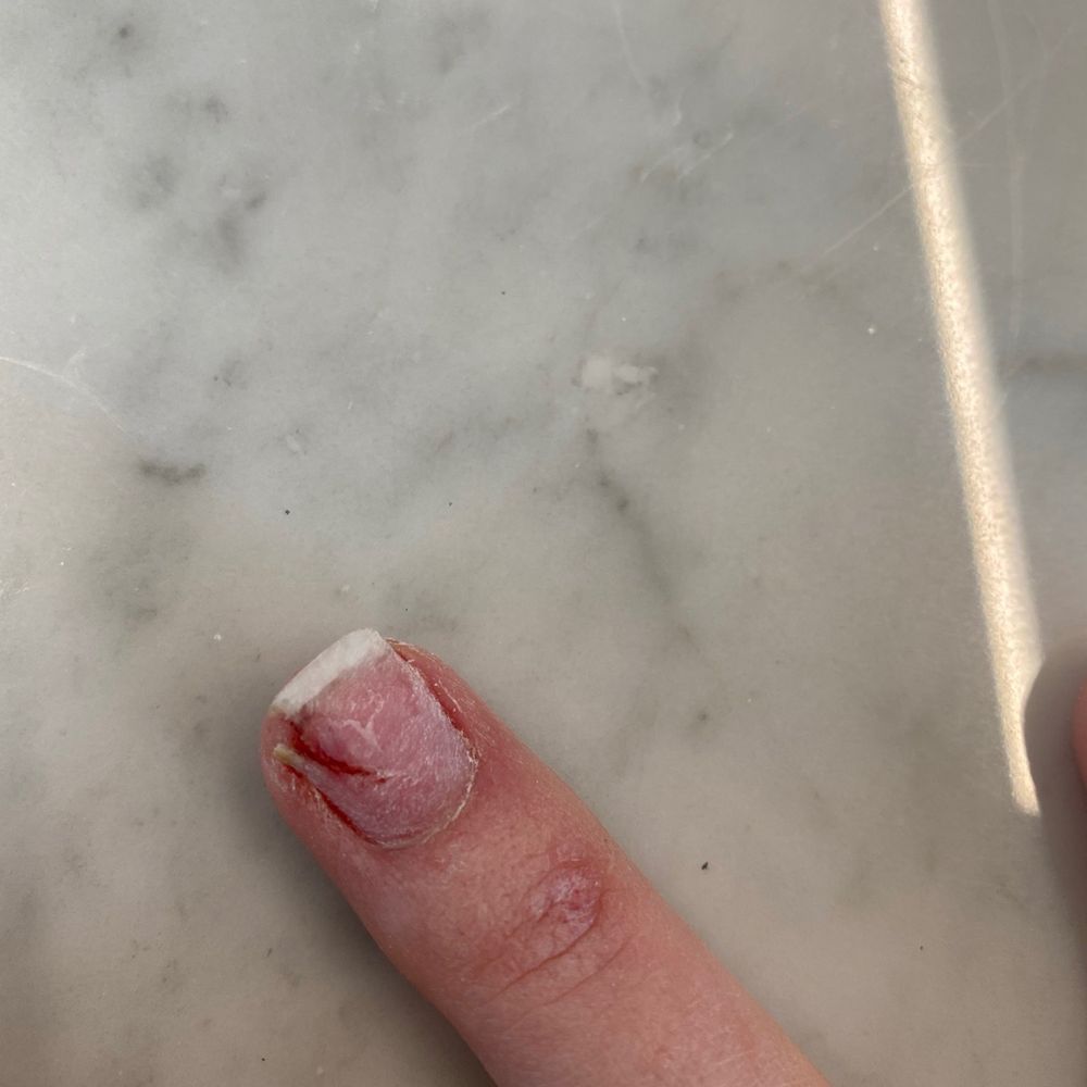 Split nail Split nail