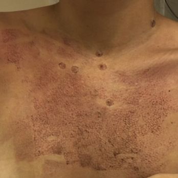 Marina Plastic Surgery - the dark spots are the "air trapped under sweat pockets" - Medical Spas Near Me - Los Angeles, California Marina Plastic Surgery - the dark spots are the "air trapped under sweat pockets" - Medical Spas Near Me - Los Angeles, California
