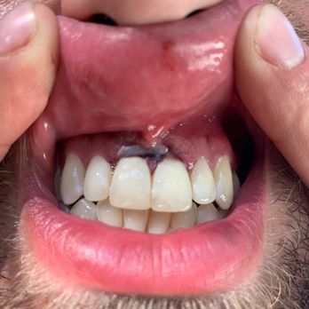 Hostel Che - Assaulted by another hostel guest. Teeth were knocked inwards. - Bed & Breakfast Near Me - Playa del Carmen, ROO