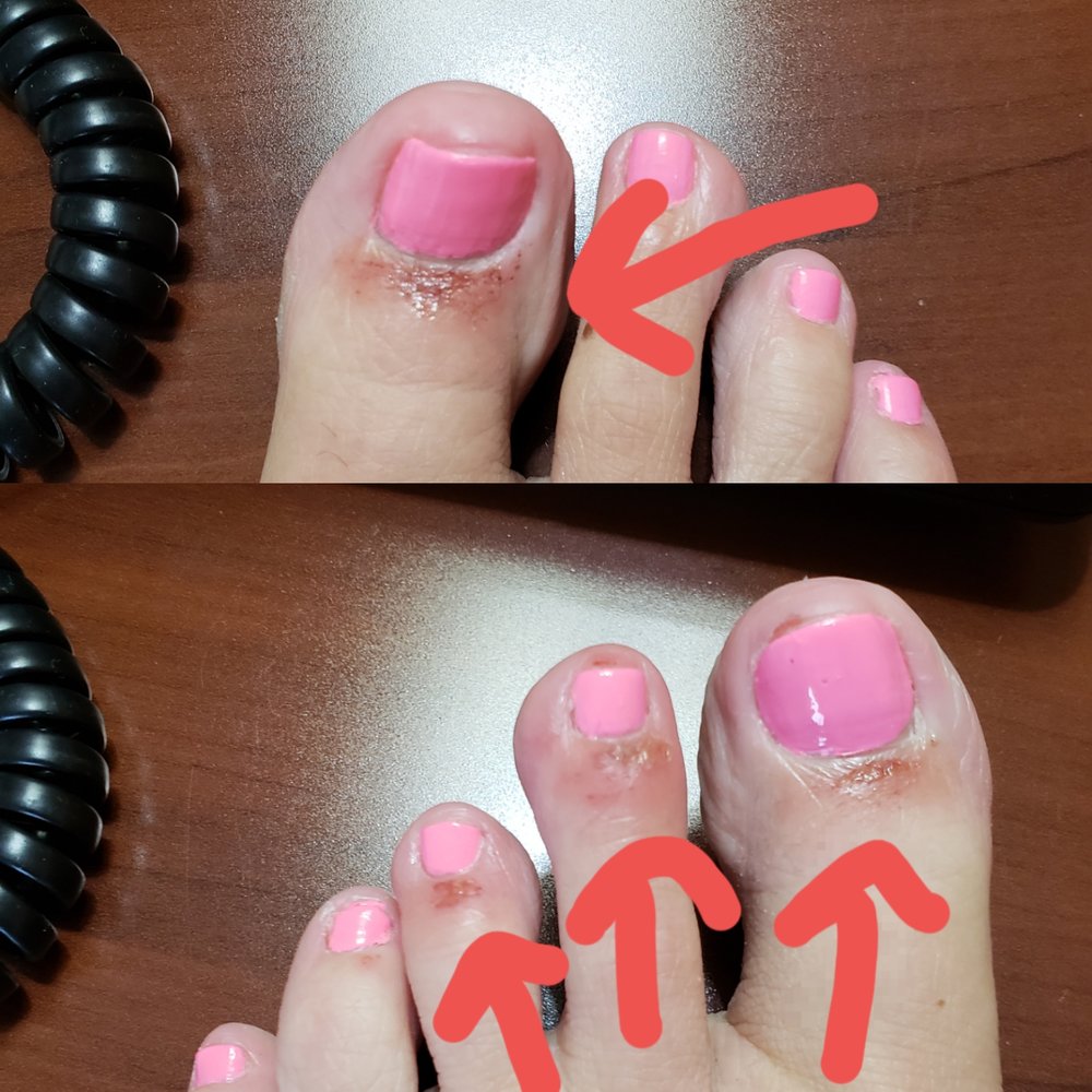 Elite Spa Nails - Oww!! I expressed several times throughout the pedicure how much it hurt. This is a picture from the day after. - Nail Salons Near Me - High Point, North Carolina Elite Spa Nails - Oww!! I expressed several times throughout the pedicure how much it hurt. This is a picture from the day after. - Nail Salons Near Me - High Point, North Carolina