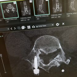 Jacksonville Brain and Spine - This shows the image of "botched"surgery    Dr. Michael Petr on my lumbar. Note the angle of the pedicle screw breaching the thecal sac.