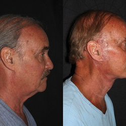 Lee Facial Plastic Surgery - Before and After from  Lee Facial Plastic Surgery  | Boston, MA