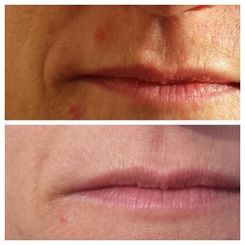 Pure Skin Bar - Before picture is on top. Microneedling stimulates collagen and elastin to minimize wrinkles and firm the skin. - Skin Care Near Me - Phoenix, Arizona Pure Skin Bar - Before picture is on top. Microneedling stimulates collagen and elastin to minimize wrinkles and firm the skin. - Skin Care Near Me - Phoenix, Arizona