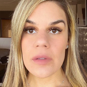Vika Aesthetics - Only two hours after my injections!! - Medical Spas Near Me - San Diego, California Vika Aesthetics - Only two hours after my injections!! - Medical Spas Near Me - San Diego, California