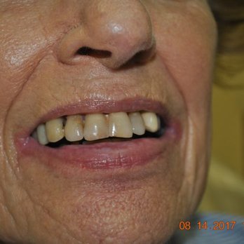 Stellar Smiles Bridgewater - Before - General Dentistry Near Me - Bridgewater, New Jersey Stellar Smiles Bridgewater - Before - General Dentistry Near Me - Bridgewater, New Jersey