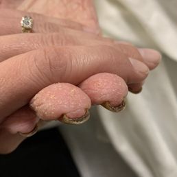 Fecal matter under nails