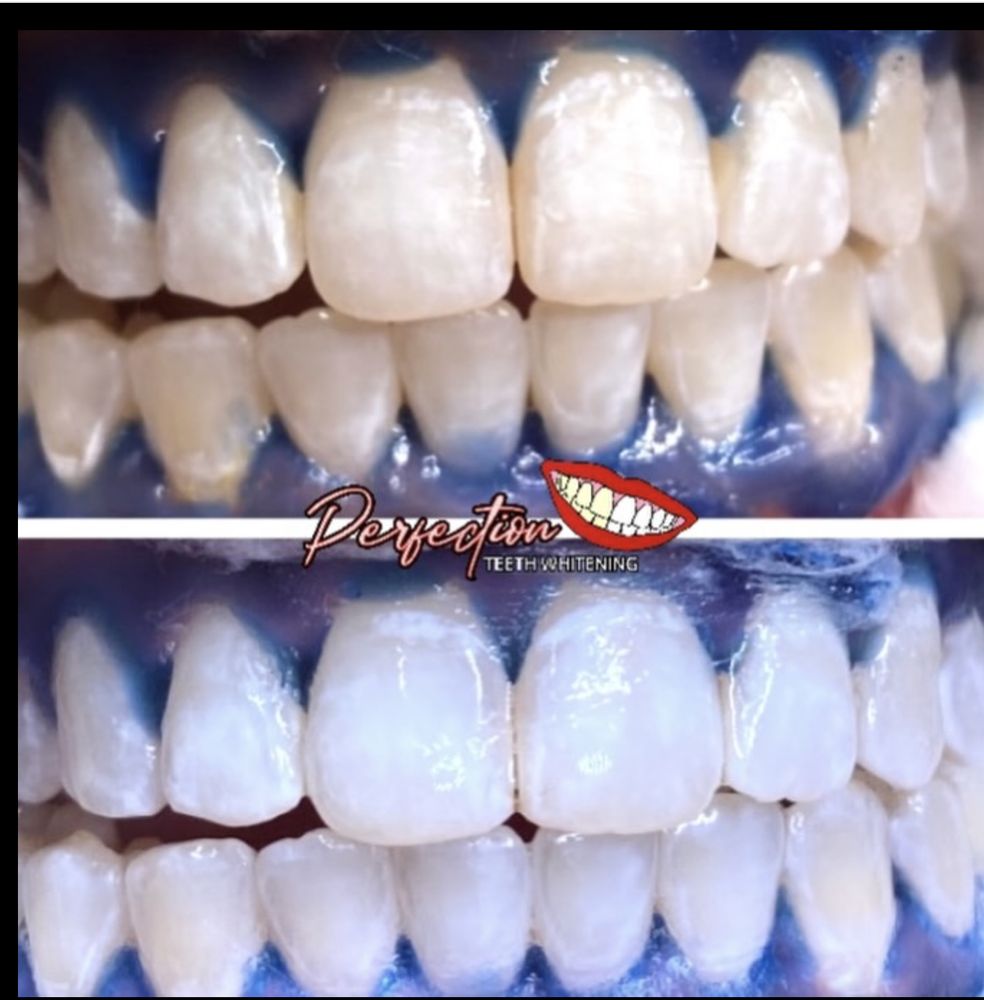 Perfection Teeth Whitening Logo