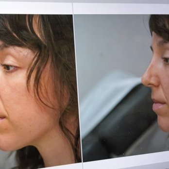 Vladimir Grigoryants, MD - My nose came out so much better than he even tried to show me! - Cosmetic Surgeons Near Me - Glendale, California Vladimir Grigoryants, MD - My nose came out so much better than he even tried to show me! - Cosmetic Surgeons Near Me - Glendale, California
