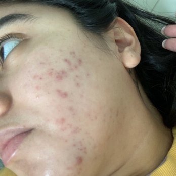 Ashtar Aesthetics - Before - Skin Care Near Me - Glenview, Illinois