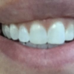 Image Dental - My tooth on the right was  shortened and flattened without my consent by Dr. McGuire for no reason. See review for full story.