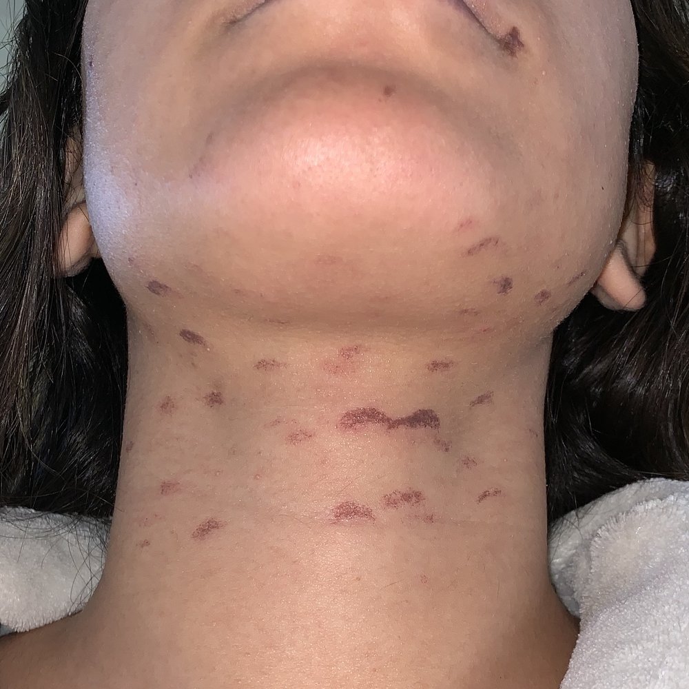 Ideal Image Willow Grove - A SCAM! Laser Hair Removal did not work and left me with burns. This is after I paid a total of $3,577.00 and completed all treatments. - Medical Spas Near Me - Willow Grove, Pennsylvania Ideal Image Willow Grove - A SCAM! Laser Hair Removal did not work and left me with burns. This is after I paid a total of $3,577.00 and completed all treatments. - Medical Spas Near Me - Willow Grove, Pennsylvania