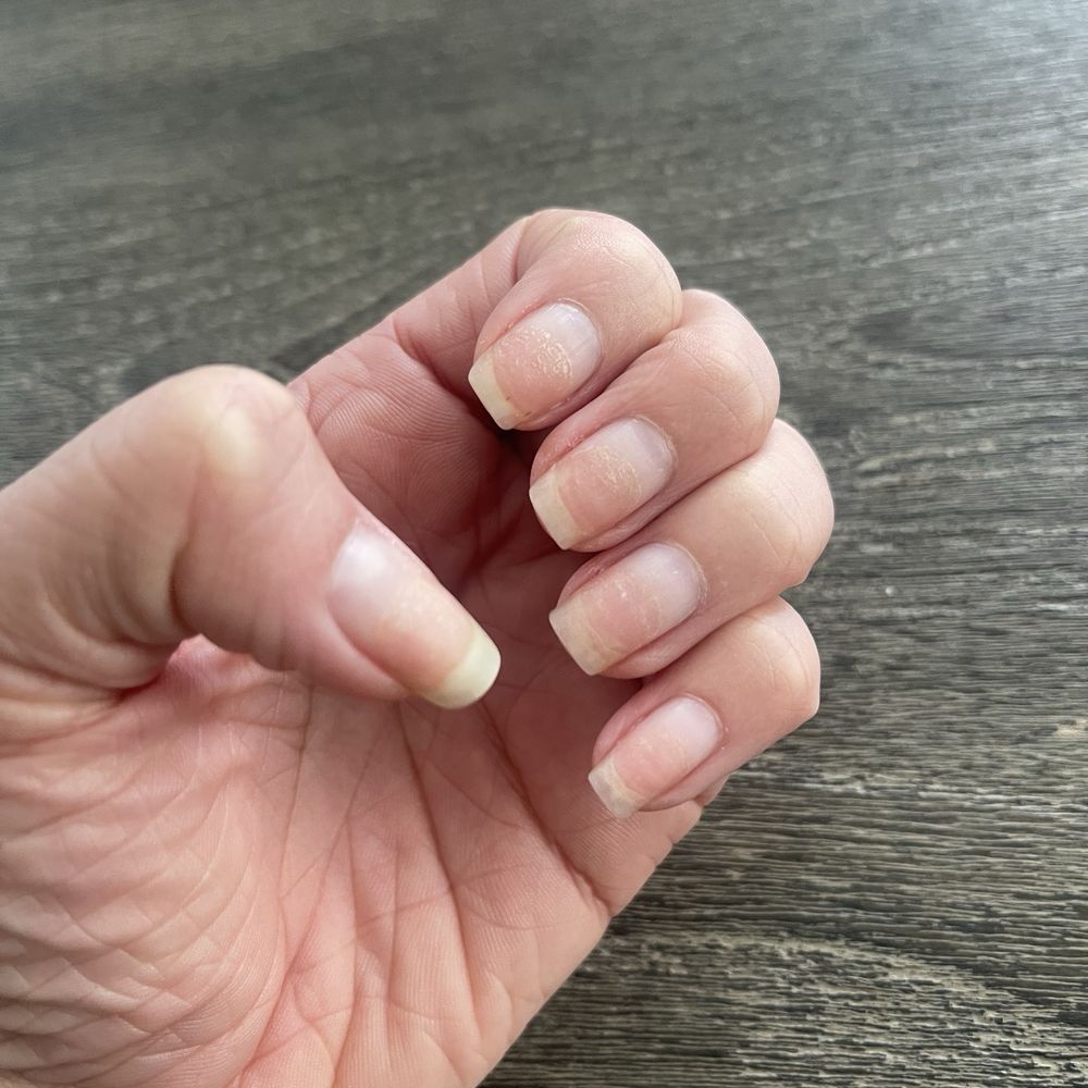 The X Nail - Growth - damaged natural nail from drill - Nail Salons Near Me - Ontario, California The X Nail - Growth - damaged natural nail from drill - Nail Salons Near Me - Ontario, California