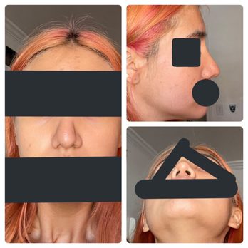 John Diaz, MD - pinched nose, droopy tip, and asymmetrical nostrils - Cosmetic Surgeons Near Me - Beverly Hills, California