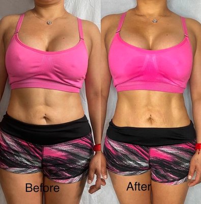 Before & After Photos - Please contact us today to book your sessions! We offer different packages to suit your needs. You can take a look at our site: https://linktr.ee/Beebodysculpting to learn more or feel free to text or call me as well at (415)761-3247 and don't forget to mention you found us on Yelp!