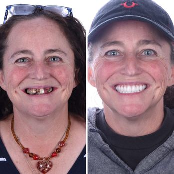 Britely Dentures + Implants Studio - Final result of full mouth dental implants! - Cosmetic Dentists Near Me - Littleton, Colorado Britely Dentures + Implants Studio - Final result of full mouth dental implants! - Cosmetic Dentists Near Me - Littleton, Colorado
