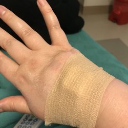 Jordan Valley Hospital Outpatient Physical Therapy - Blown veins