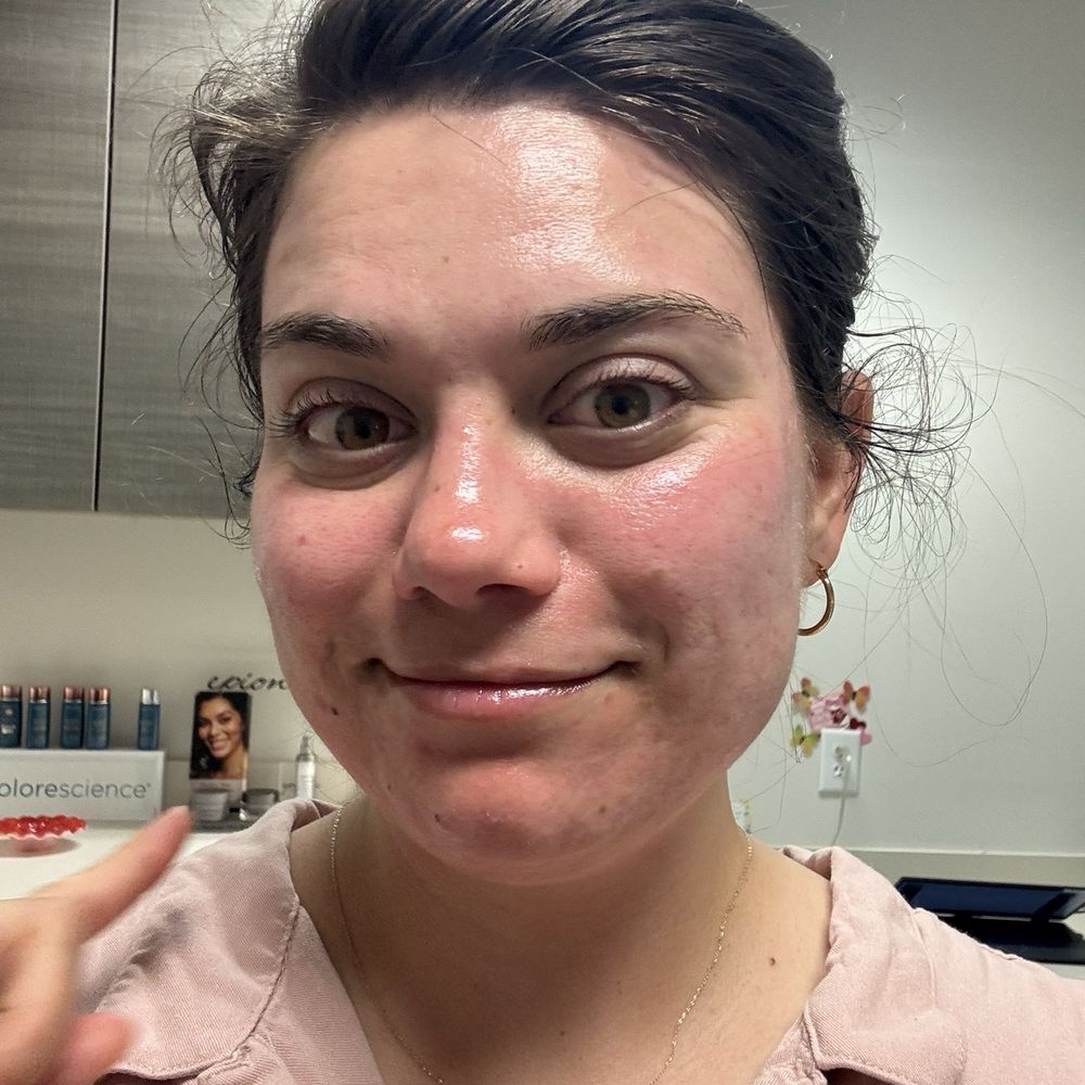 Pariser Dermatology Specialists - After hydrafacial - Dermatologists Near Me - Norfolk, Virginia Pariser Dermatology Specialists - After hydrafacial - Dermatologists Near Me - Norfolk, Virginia