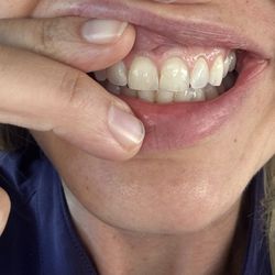 Fixed chip tooth with bonding option- after