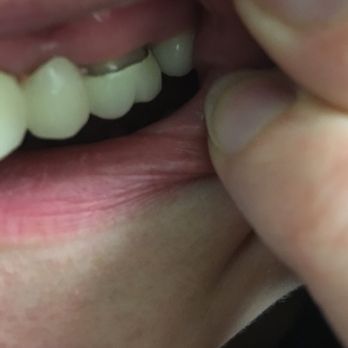 Soft Touch Dental - Product of their work - General Dentistry Near Me - Houston, Texas