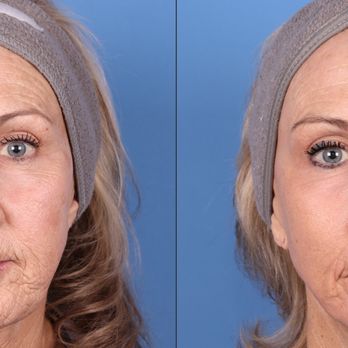 Guy Cappuccino, MD - Plastic Surgeons Near Me - Mount Airy, Maryland Guy Cappuccino, MD - Plastic Surgeons Near Me - Mount Airy, Maryland