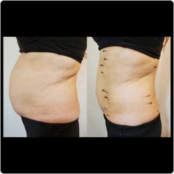 Instant Inch Loss Chicago - Great results after an 8 treatment package!