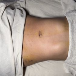 AcuSpa Wellness Center - Post surgery lymphatic drainage massage