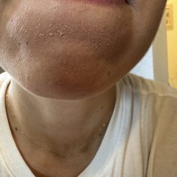 My flaky dry skin before my facial My flaky dry skin before my facial