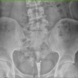 X-Ray Before