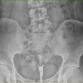 Kore Chiropractic - X-Ray Before - Chiropractors Near Me - Bellevue, Washington