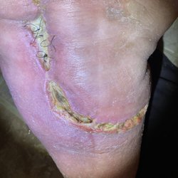 James H Carson, MD - Infection