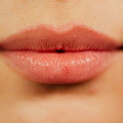 Coastal Dermatology and Medical Aesthetics - Dermal Fillers