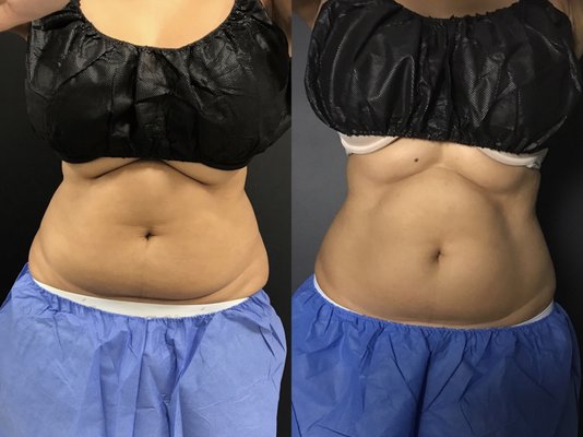 CoolSculpting® - What is CoolSculpting?

CoolSculpting is a versatile body contouring treatment that freezes fat cells to the point they can no longer function properly. In the months following your CoolSculpting procedures, your body gradually eliminates the damaged fat cells through the lymphatic system. In turn, the areas you targeted during your treatment diminish in size. 

Self Care LA offers CoolSculpting services for athletes who want to streamline their physiques, as well as to men and women who simply want to reduce body fat for aesthetic reasons. No matter your fitness level, CoolSculpting can effectively remove fat cells that don’t seem to go away despite your best exercise and dieting efforts. 

During a consultation, Dr. Kothakota goes over your medical history to be sure your body will respond well to the treatments. CoolSculpting is not a weight-loss procedure and should not be treated as such: You should consider it only if you’re comfortable at your current weight or nearing your weight loss goals. 

Which areas can I target with CoolSculpting?

Coolsculpting is unique because of its ability to treat so many areas of your body. You don’t have to limit it to just one or two: You can treat many areas within a customized treatment plan at Self Care LA.

Dr. Kothakota routinely treats these areas with CoolSculpting:

Arms

Banana roll

Bra fat

Calves

Chin and neck

Knees

Love handles (flanks)

Male chest

Stomach 

Thighs


Your fat distribution may be completely different from another person’s, even if they have a similar body structure, which is why customizing treatments like CoolSculpting is essential to get to your ideal results. 

How can I make my CoolSculpting results last?

CoolSculpting doesn’t require much aftercare after your treatments, but if you want to maintain your results, you’ll have to stick to a healthy lifestyle. It’s important to maintain a well-balanced and nutritious diet to keep from developing new fat cells in the areas you targeted with CoolSculpting.
Alongside a healthy diet, integrating exercise into your routine helps you maintain a faster metabolism and a more muscular or toned physique. 

To schedule your treatment consultation for CoolSculpting, call Self Care LA or book an appointment online today.