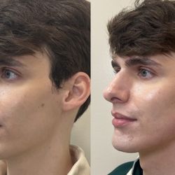 Left: before -- Right: immediately after