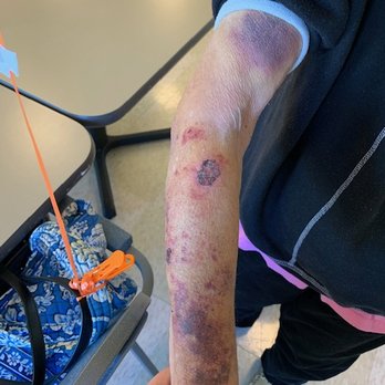 Olney Memory Care by Artis - No explanation given for her arm - Assisted Living Facilities Near Me - Olney, Maryland Olney Memory Care by Artis - No explanation given for her arm - Assisted Living Facilities Near Me - Olney, Maryland
