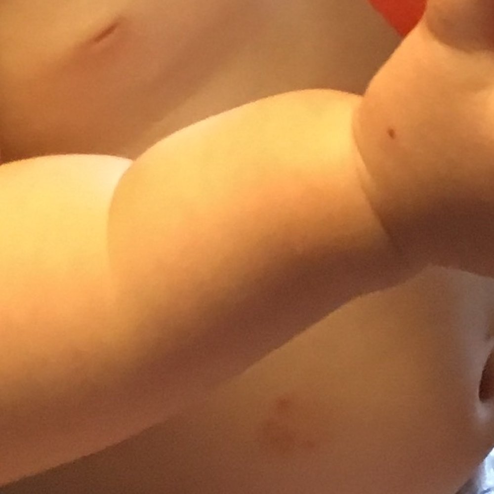 Gig Harbor KinderCare - stomach bite mark close up - Child Care & Day Care Near Me - Gig Harbor, Washington