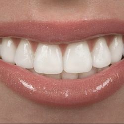 The Whittier Dentist - Dental Veneers & Cosmetic Fillings To Fix Spacing, Coloring, or Not Pretty Teeth
