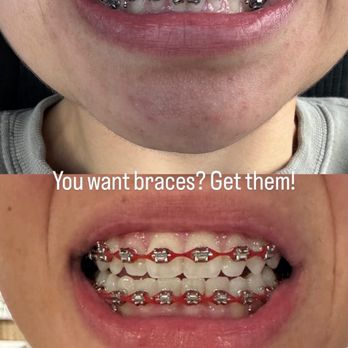Renton Smiles Orthodontics - Braces - Orthodontists Near Me - Renton, Washington Renton Smiles Orthodontics - Braces - Orthodontists Near Me - Renton, Washington
