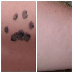 First Class Tattoo Removal Service - Before treatment after 6 treatments