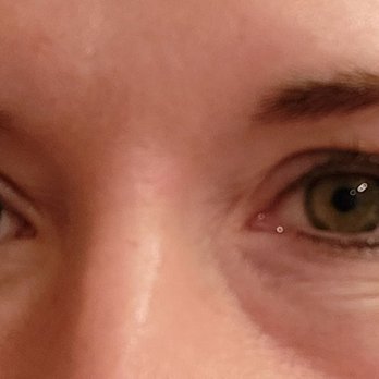Aesthetics, by Dr. Lee - 3.5 months since under eye filler. I told Dr Lee right away that they were asymmetrical. It is embarrassing to smile. - Aestheticians Near Me - Granite Bay, California Aesthetics, by Dr. Lee - 3.5 months since under eye filler. I told Dr Lee right away that they were asymmetrical. It is embarrassing to smile. - Aestheticians Near Me - Granite Bay, California