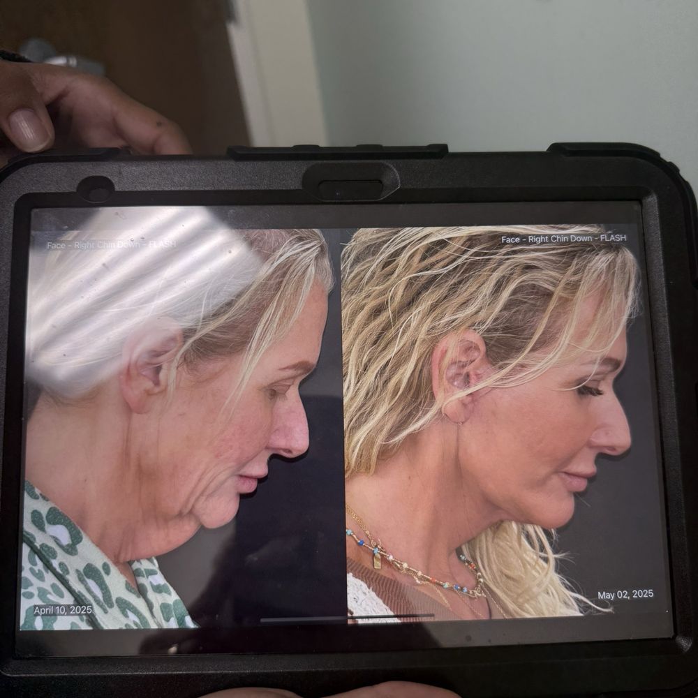 ImageLift - Results 3 weeks after surgery I'll let Dr. Johnson work speak for themselves - Cosmetic Surgeons Near Me - The Villages, Florida ImageLift - Results 3 weeks after surgery I'll let Dr. Johnson work speak for themselves - Cosmetic Surgeons Near Me - The Villages, Florida