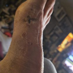 Vincenzo Palmieri, DPM - Post bonion after 4 weeks
