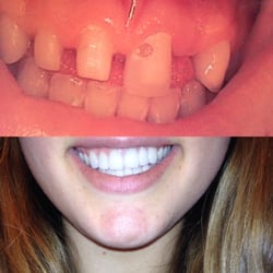 Before and after of my teeth. Dr Collins is amazing!