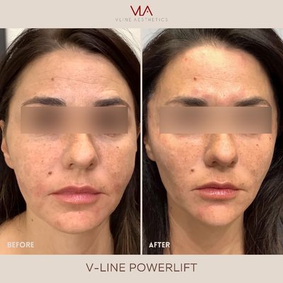 Cheek - Cheek Filler. Come in for a free consultation, all treatments can be converted to tailor your needs. Cheek - Cheek Filler. Come in for a free consultation, all treatments can be converted to tailor your needs.