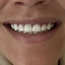 Classic chiclet veneer fail