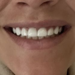 South Kipling Dental Care - Classic chiclet veneer fail