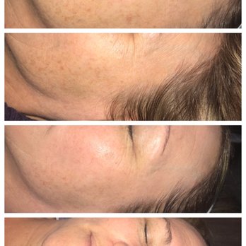 Skin Care Essentials - Vitamin A Peptide Series. 3 peels done every 10 days. - Skin Care Near Me - Highlands Ranch, Colorado Skin Care Essentials - Vitamin A Peptide Series. 3 peels done every 10 days. - Skin Care Near Me - Highlands Ranch, Colorado