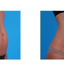 Byrd Lipedema Surgery Center